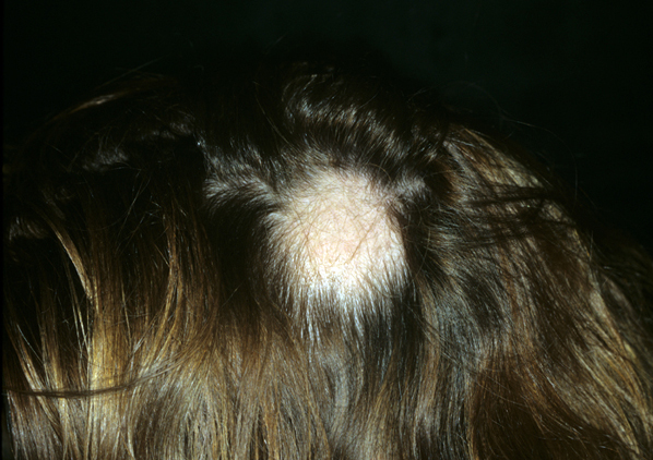 7 cosas que tu pelo dice sobre tu salud - 3.	“Tengo parches sin pelo”